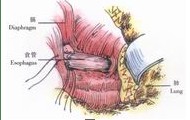 示意图12:固定食管下段与裂孔