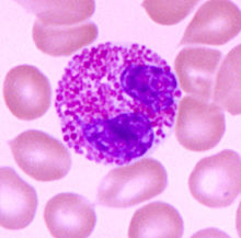 嗜酸粒细胞病理图 嗜酸粒细胞病理图